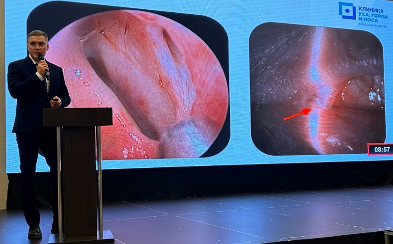 Наш хирург Якунин С.А. представил уникальный опыт эндоскопической дакриоцисториностомии